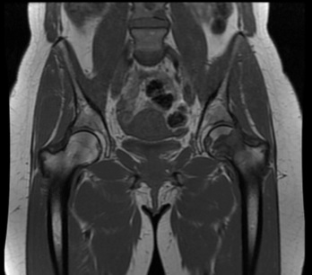 Figure 2 for case MALT lymphoma